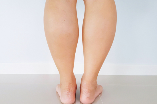 Can-Exercise-Replace-6996a6407a531-1 Can Exercise Replace Calf Reduction Surgery?