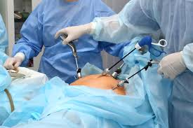 How-Long-Does-Laparo-69a6b4464e38a-1 How Long Does Laparoscopic Surgery Take?