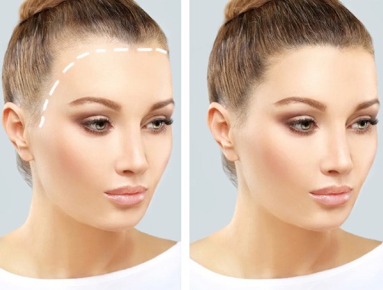 Private: Hair-Transplant-in-Dubai-1.jpg