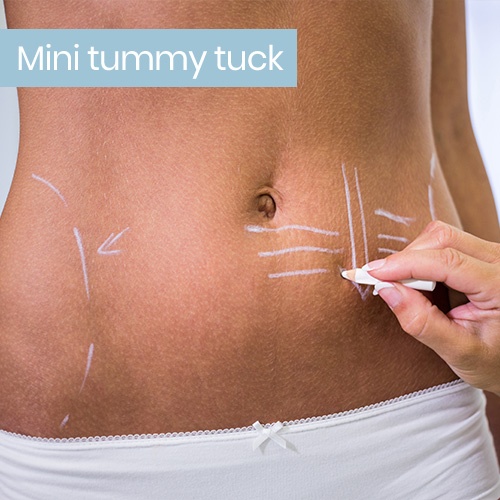 Private: Mini-Tummy-Tuck-4.jpg