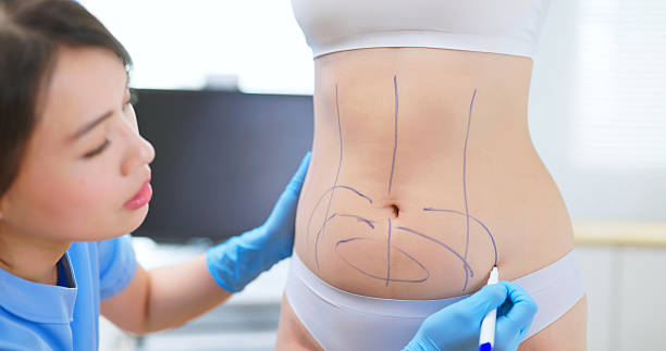Private: Liposuction-in-Riyadh-4.jpg
