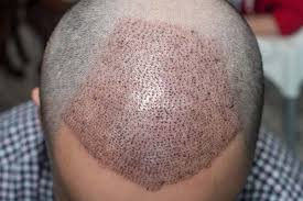 Private: hair-transplant-2-1.jpg